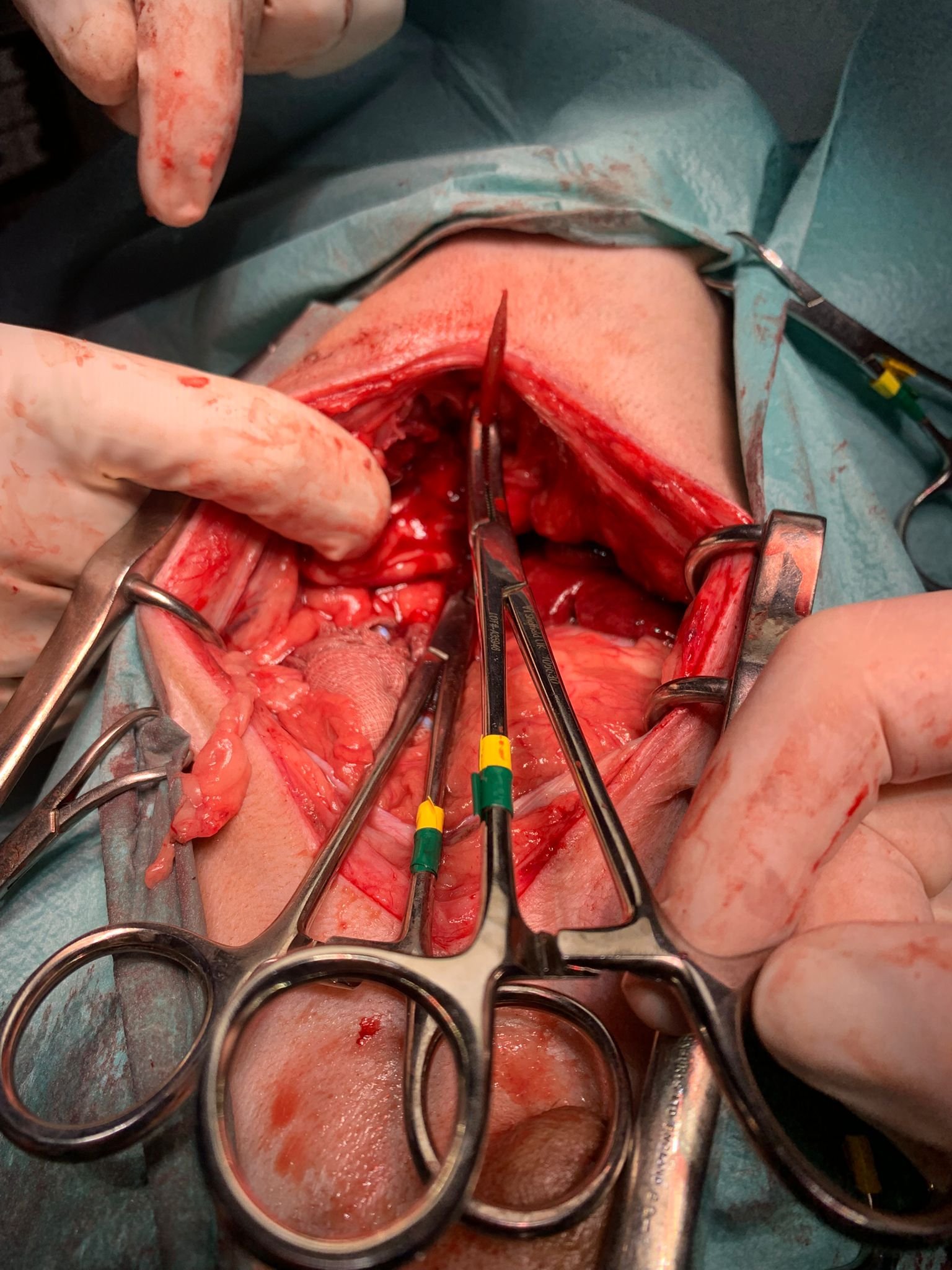 Foreign body removal case